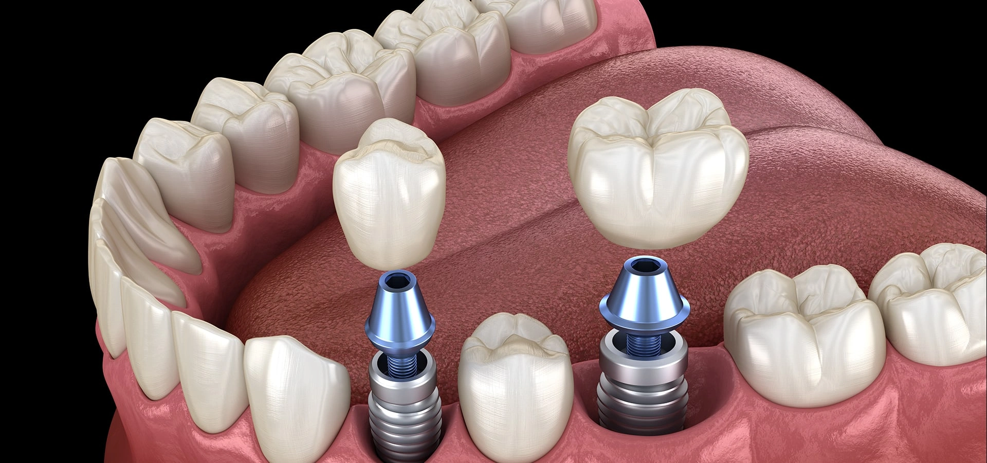 Dental implant model showing tooth replacements with metal posts in gum tissue.