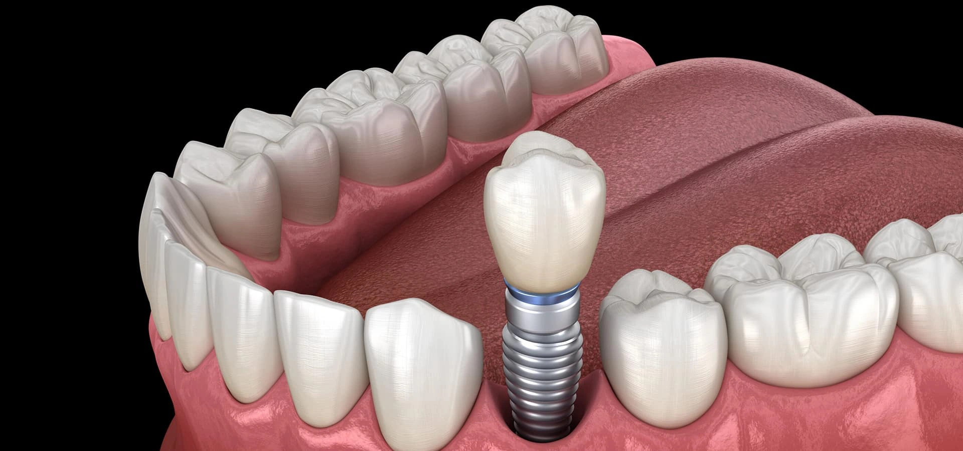 Dental implant illustration showing artificial tooth fixture in jawbone with surrounding natural teeth and gum tissue.